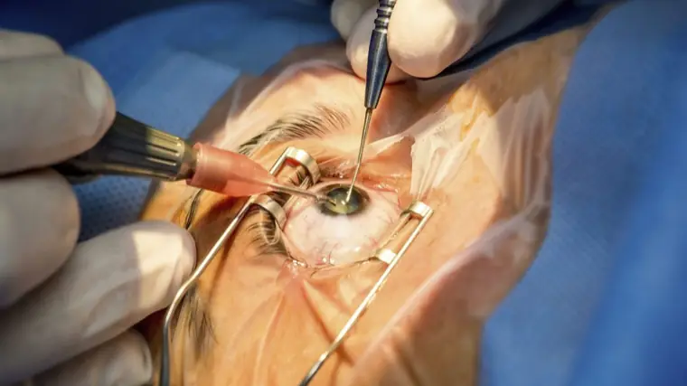 Cirurgia de catarata